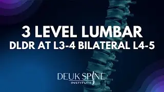 3 Level Deuk Laser Disc Repair at L3-4, Bilateral L4-5 of the Lumbar Spine