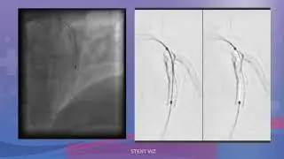 ANGIOPLASTIA COMPLEJA OCLUSION TOTAL DE RAMO DIAGONAL