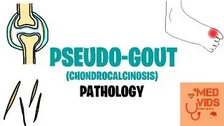 PSEUDOGOUT PATHOLOGY | MED VIDS MADE SIMPLE