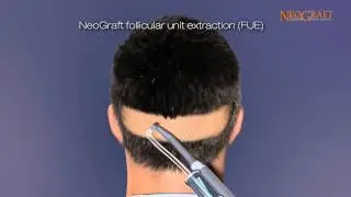 NeoGraft Animated Hair Restoration Video - See how Surgery can Restore Your Hair