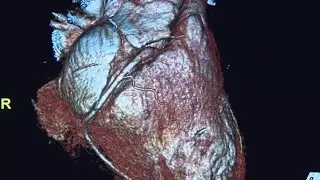 How the University of Missouri Health Care is helping patients catch potential cardiovascular iss...