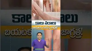 Varicose Veins Symptoms | Varicose Vein Glue Treatment | Health Tips In Telugu | Dr Sridhar Reddy