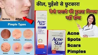 Acnestar gel ✅ review in hindi | Pimples ki best cream aur Soap uses side effects 