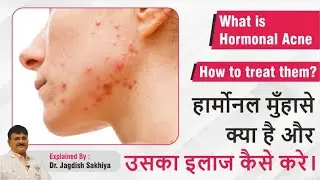 What is Hormonal Acne & How to Treat Them | What is hormonal acne and how to treat it.