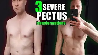 3 SEVERE SUNKEN CHEST TRANSFORMATIONS with Exercise Only (NO SURGERY!)