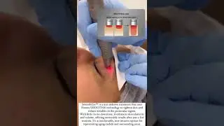 Transform Your Eyes with SmoothEye: Revolutionary Fotona Smooth Technology for Ageless Beauty
