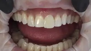 Rebel.dental mock-up tutorial - Incisal edge vertical position - elongate