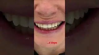 #dentifissi con #capsule in #zirconia e #faccettedentali
