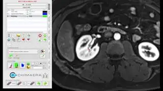 Kidney Annotation using a Smart-Brush