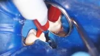 Using Temporary Restorative Material - Dr. Scott Norton