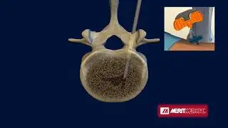 Merit Medical: StabiliT Vertebral Augmentation System