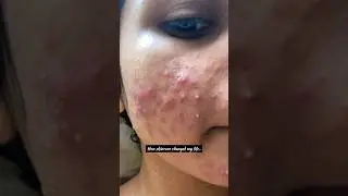 How skincare changed my life 🌸