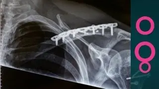 Glue for broken bones