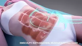 EMSCULPT Beverly Hills | Build Muscle & Burn Fat in Los Angeles - Lasky Aesthetics