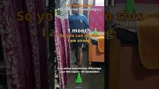 1 month after ACL InternalBrace Surgery #aclsurgeryrecovery #askdrmanu