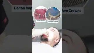From Tooth Loss to a Confident Smile | Dental Implants in Turkey