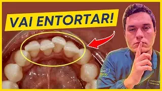 Seus incisivos VÃO entortar com o tempo… a menos que você faça ISSO.