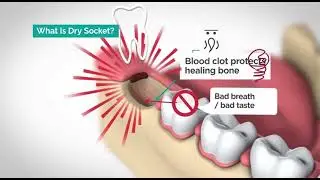 🦷 Severe Pain After Wisdom Tooth Extraction? It Could Be Dry Socket