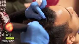 PRP Treatment for Hair Loss at BodyRx Louisville