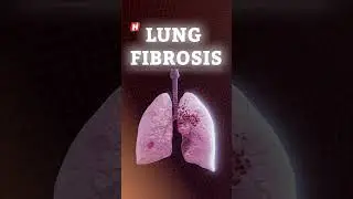 When pigeons make you sick: The hidden urban lung threat in India