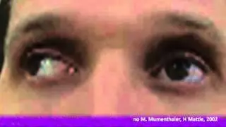 Рассеянный склероз. Часть 1 (Multiple sclerosis. Part 1)