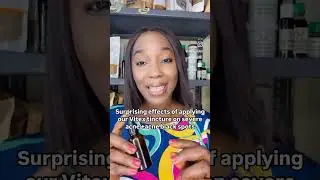Surprising effects of applying our Vitex tincture on severe acne plus acne black spots