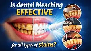 Is dental bleaching effective for all types of stains?