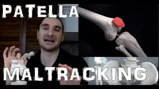 Help Fix Patellar Maltracking From A Tight IT Band With This Tip!