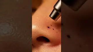 Calm Whisper ASMR | Realistic Hand Blackhead Removal | Deep Skin Care Session