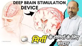 Deep Brain Stimulation Device | मिर्गी के मरीज का ईलाज | Medical Invention | Current Affairs