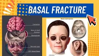 Basal fracture Full Detail lecture