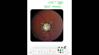How to determine the cup disc ratio(CDR)