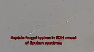 Septate hyphae in KOH mount of Sputum