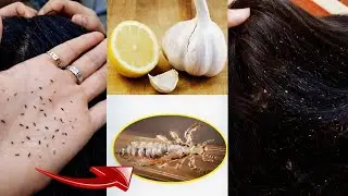 Remove Lice Naturally with Lemon, Juain Khatam Karne Ka Tarika