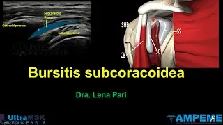 Como evaluar la bursitis subcoracoidea? Dra. Lena Pari