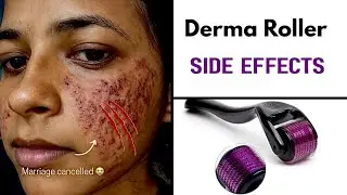 BENEFITS  -  SIDE EFFECTS  OF  USING  DERMA ROLLER  ON  FACE || HONEST REVIEW 