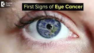 What are the first signs of eye cancer? - Dr. Sunita Rana Agarwal