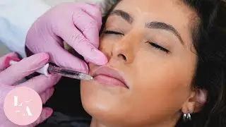 Never Had Lip Filler? Here's What It's Like!