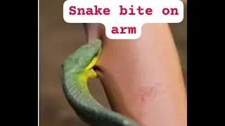 Snake 🐍 bite first aid/Dangerous snake bite tips/Precautions and prevention