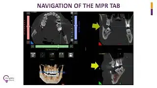 Insights Diagnostic - iRYS Software Tutorial - Navigation of the MPR Tab