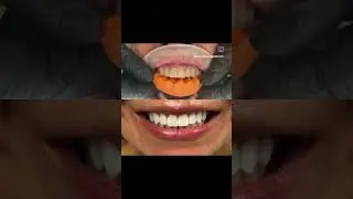 Summer Radiance: Personalized Smile Perfection with DSD
