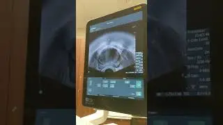 Depositing Fiducial Markers into Prostate, 20220920