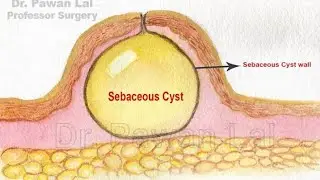 Sebaceous & Dermoid Cysts | MSK Module