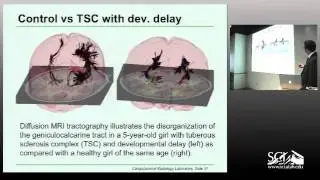 Assessing diffusion features of white matter in tuberous sclerosis and autism