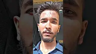 minoxidil beard transformation minoxidil beard results #beardstatus #beardtransformation #minoxidil