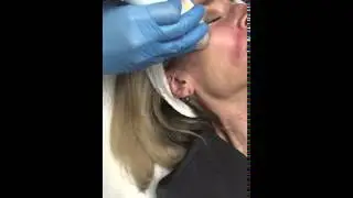 TriFractional Treatment