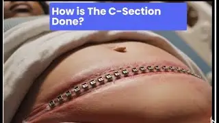 How does C-Section Really Work?