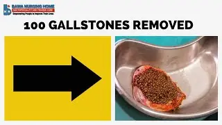 100 Gallstones removed | Gallbladder Stone Surgery | Patient Success Story | #bawanursinghome #india