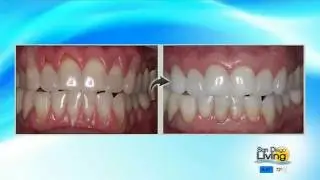 Dr. Tina Beck Describes Chao Pinhole Gum Rejuvenation On San Diego Living