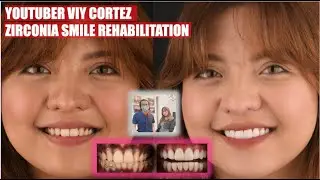 Viy Cortez Smile Rehabilitation | Apostol Dental Philippines